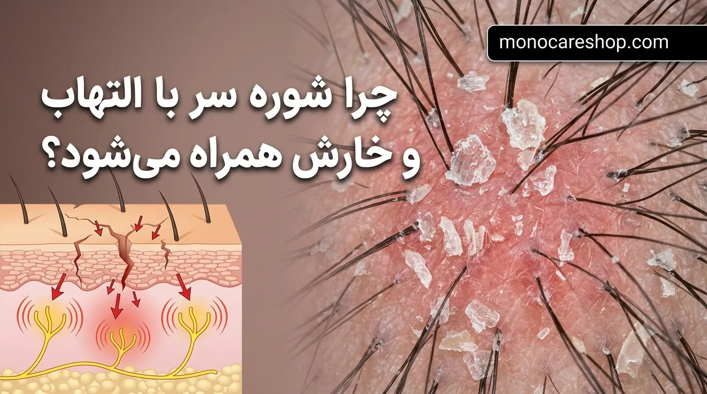چرا شوره سر با التهاب و خارش همراه میشود؟