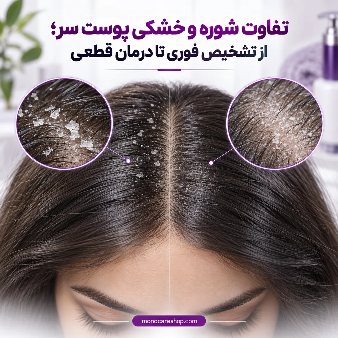 تفاوت شوره و خشکی پوست سر؛ از تشخیص فوری تا درمان قطعی