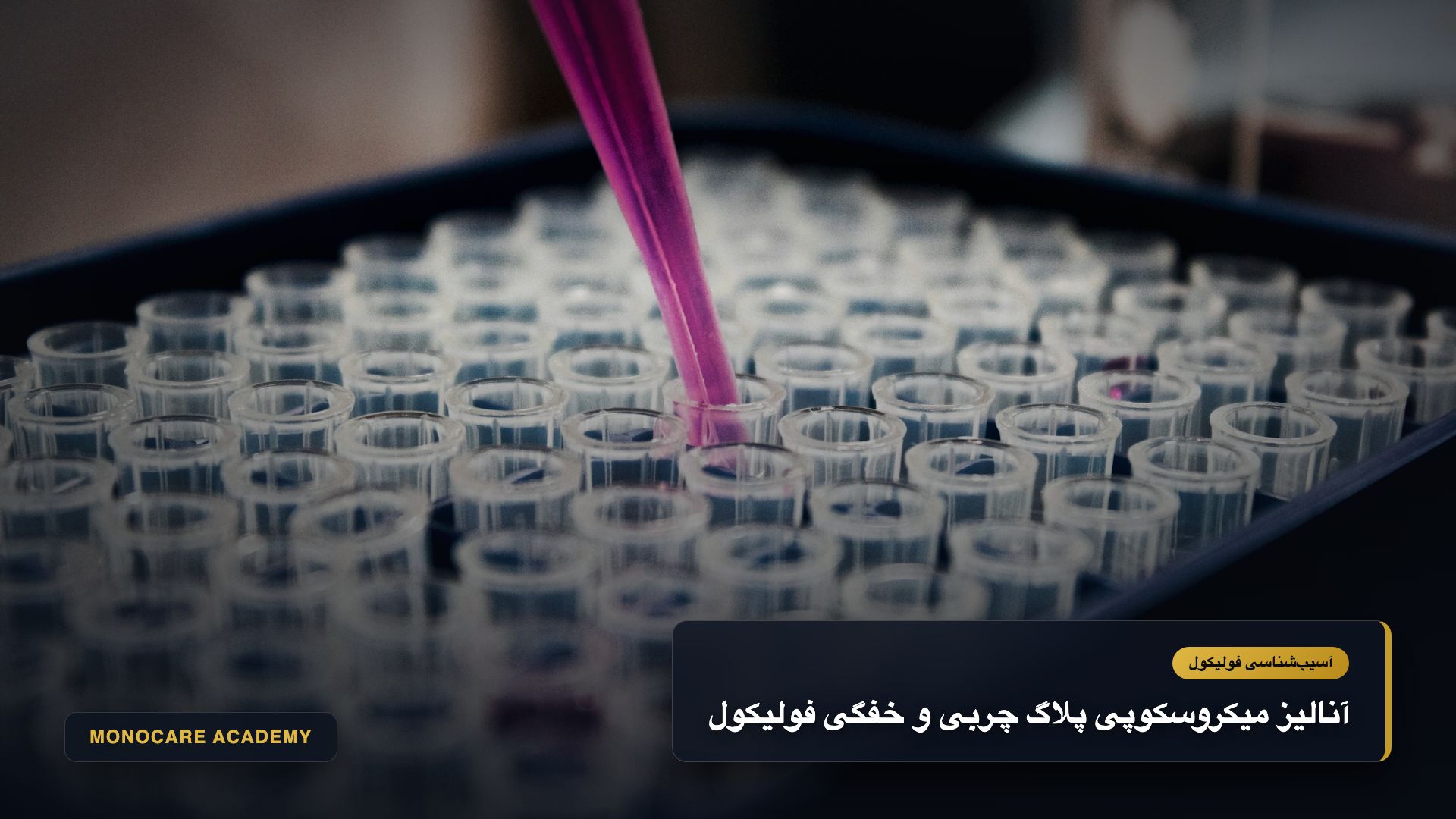 بررسی میکروسکوپی انباشت سبوم اکسیدشده و کراتین سختشده در منافذ مسدود پوست سر