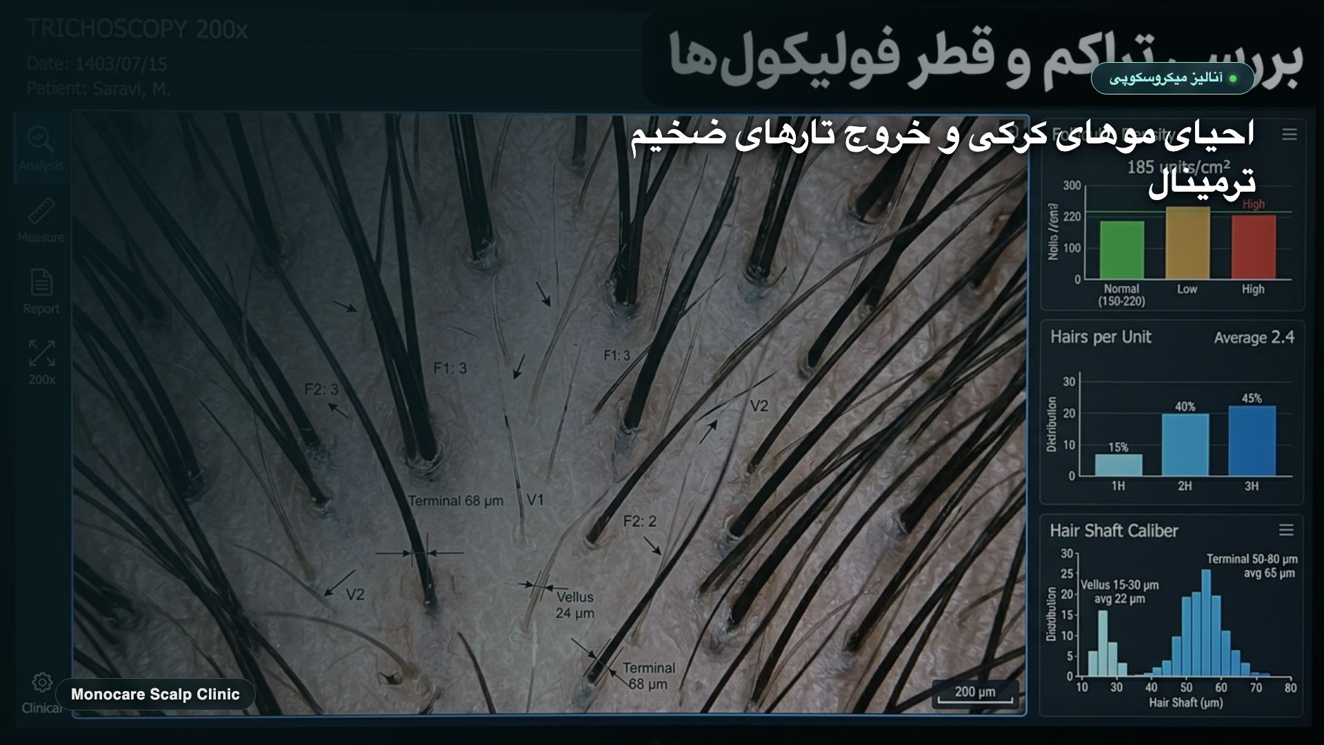 تریکوسکوپی رویش تارهای ضخیم و ترمینال از منافذ تمیز پوست سر پس از روتین پاکسازی عمقی اسکالپ