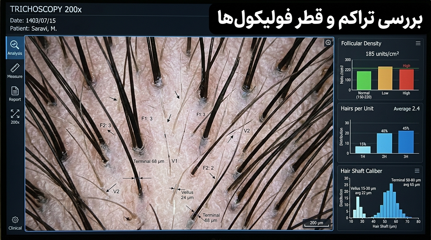 تصویر میکروسکوپی بزرگنمایی ۲۰۰ برابر از تراکم فولیکولی و تمایز تارهای ترمینال و ولوس